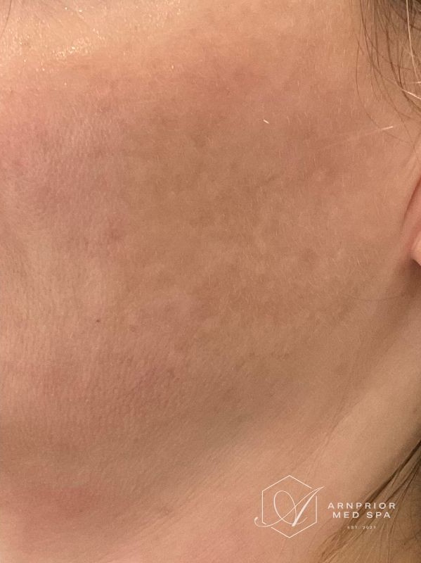Melasma after laser toning treatment