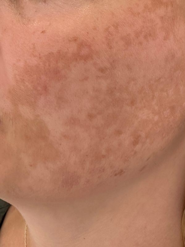Melasma before laser toning treatment