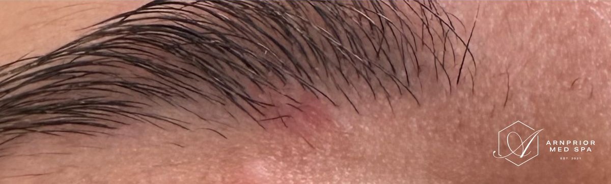 Mole removal in eyebrow after with Plexr at Arnprior Med Spa