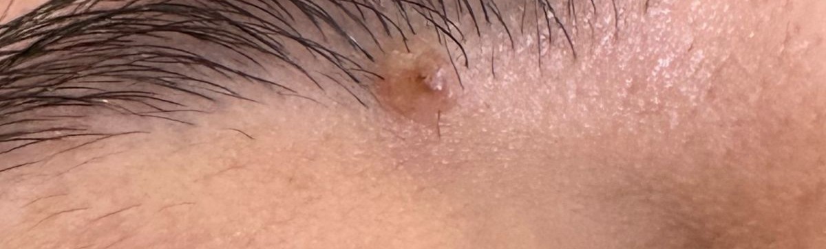 Mole removal in eyebrow before with Plexr at Arnprior Med Spa