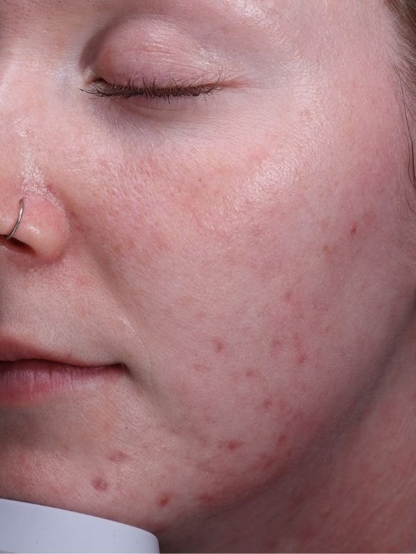 Acne scarring and texture before Mosaic 3D laser resurfacing at Arnprior Med Spa