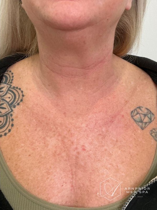 Neck and chest after CO2 skin resurfacing single session