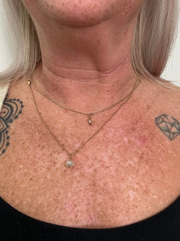 Neck and chest before CO2 skin resurfacing single session