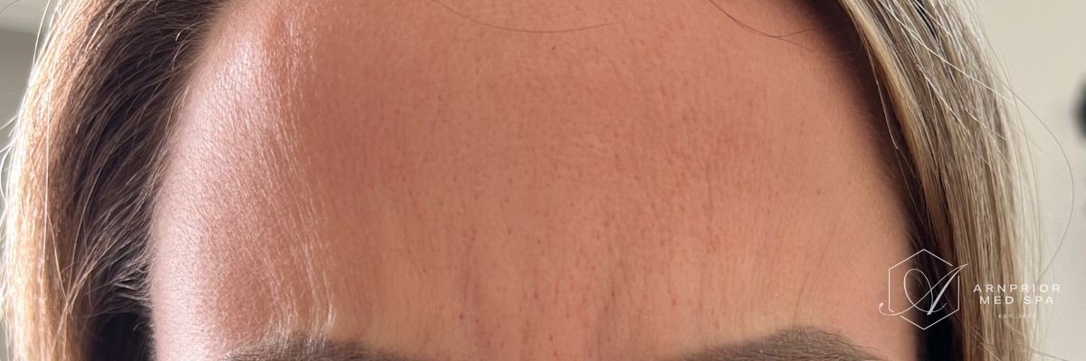 Forehead wrinkles after Dysport in Arnprior ON