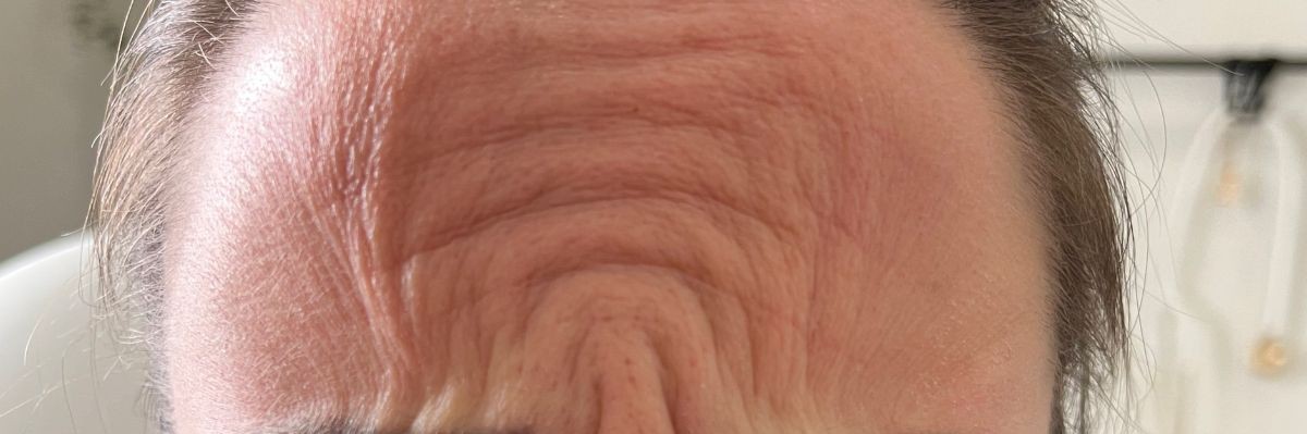 Forehead wrinkles before Dysport in Arnprior ON