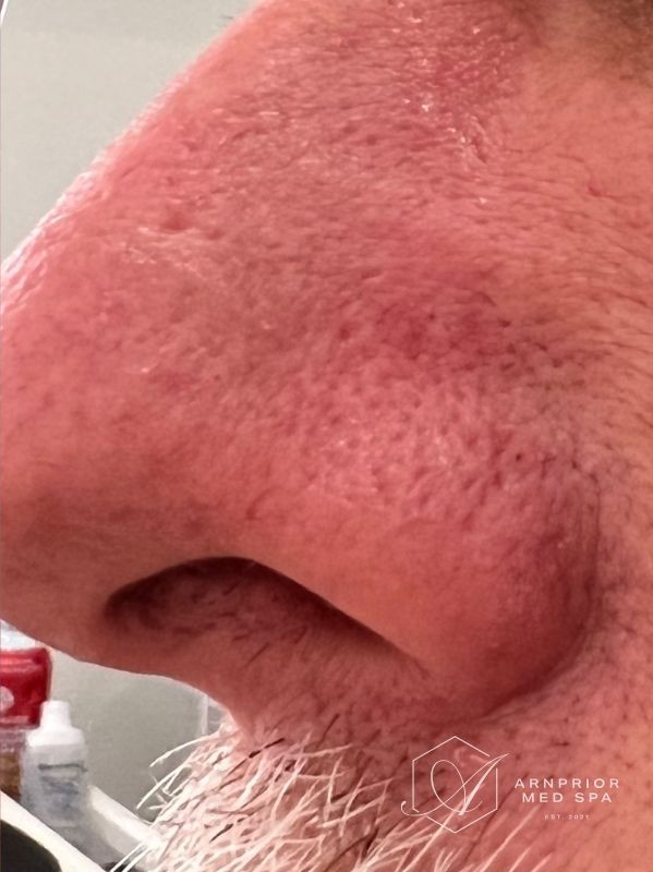 Nose benign lesion after Removal with Plexr plasma device