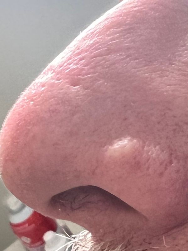 Nose benign lesion before Removal with Plexr plasma device
