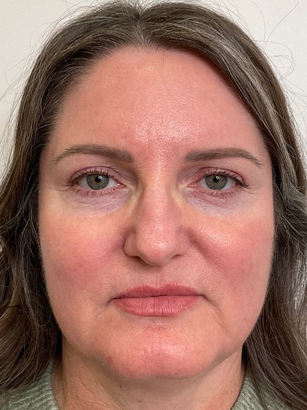 Hyperpigmentation after laser resurfacing at Arnprior Med Spa