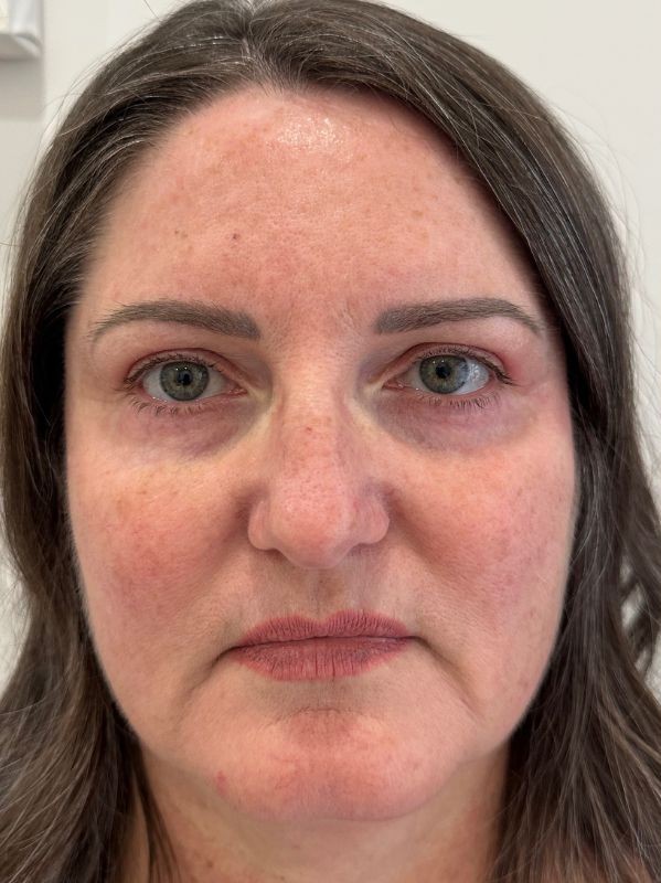 Hyperpigmentation before laser resurfacing at Arnprior Med Spa