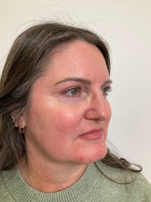 Pigmentation after laser resurfacing at Arnprior Med Spa