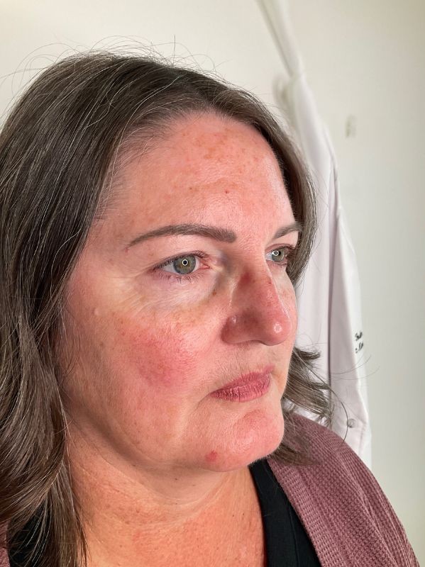 Pigmentation before laser resurfacing at Arnprior Med Spa
