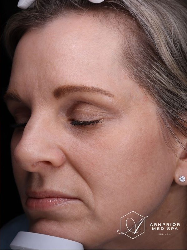 Hyperpigmentation after LaseMD Ultra