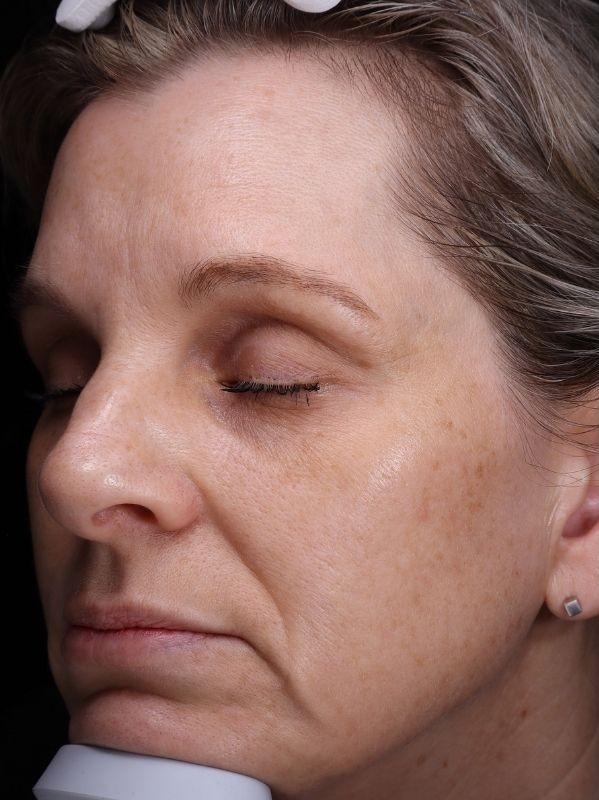 Hyperpigmentation before LaseMD Ultra