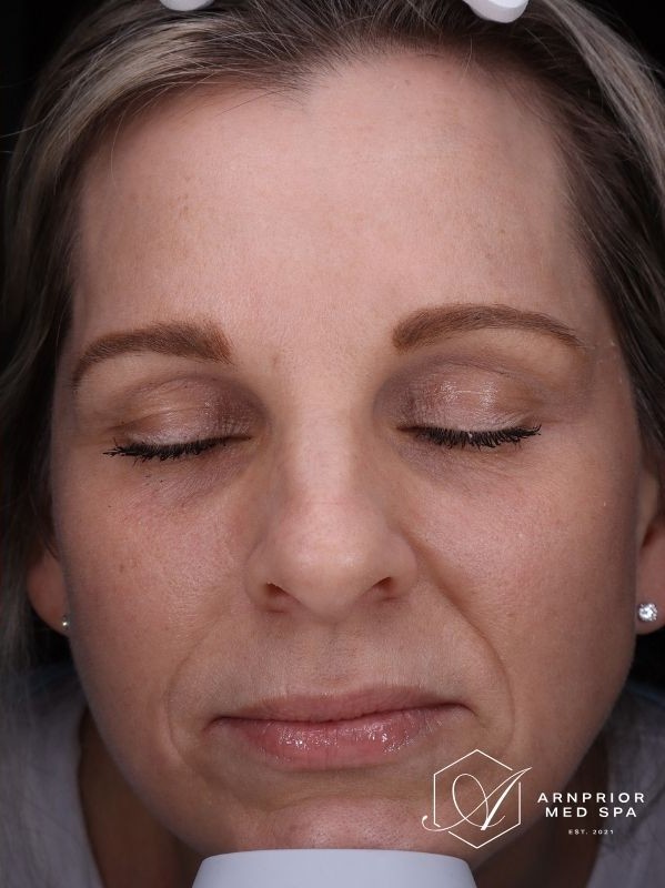 Hyperpigmentation after LaseMD Ultra