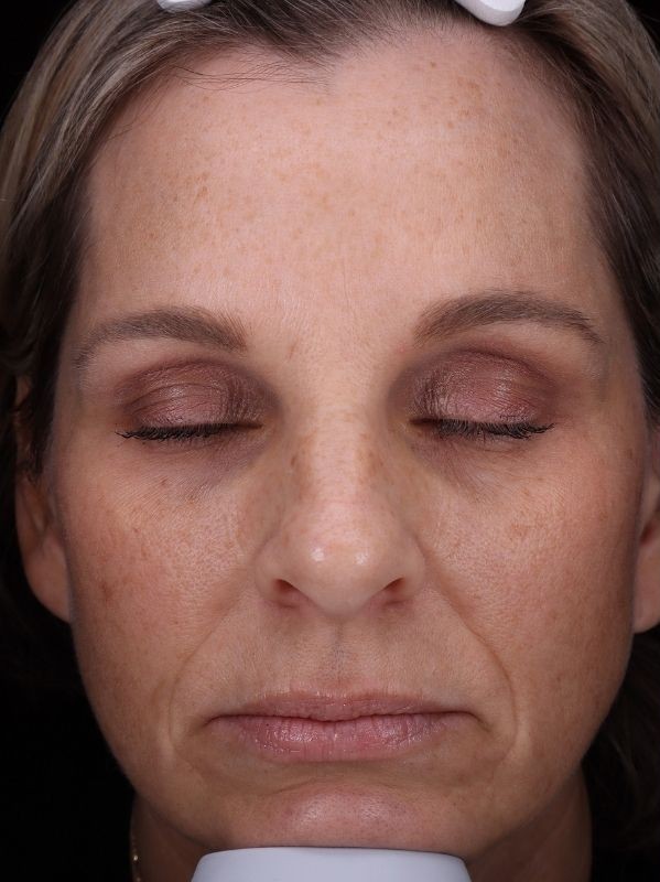Hyperpigmentation before LaseMD Ultra