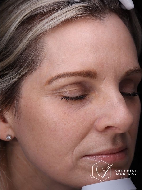 Hyperpigmentation after LaseMD Ultra in Arnprior Ontario