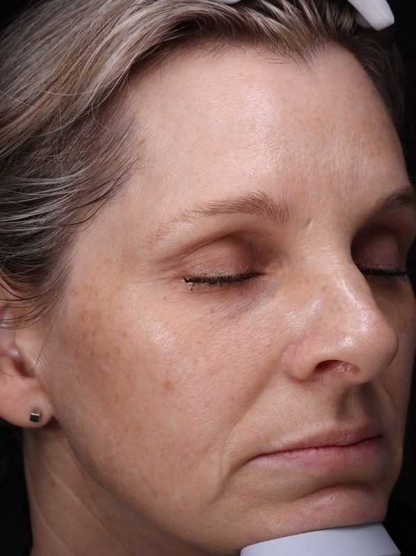 Hyperpigmentation before LaseMD Ultra in Arnprior Ontario
