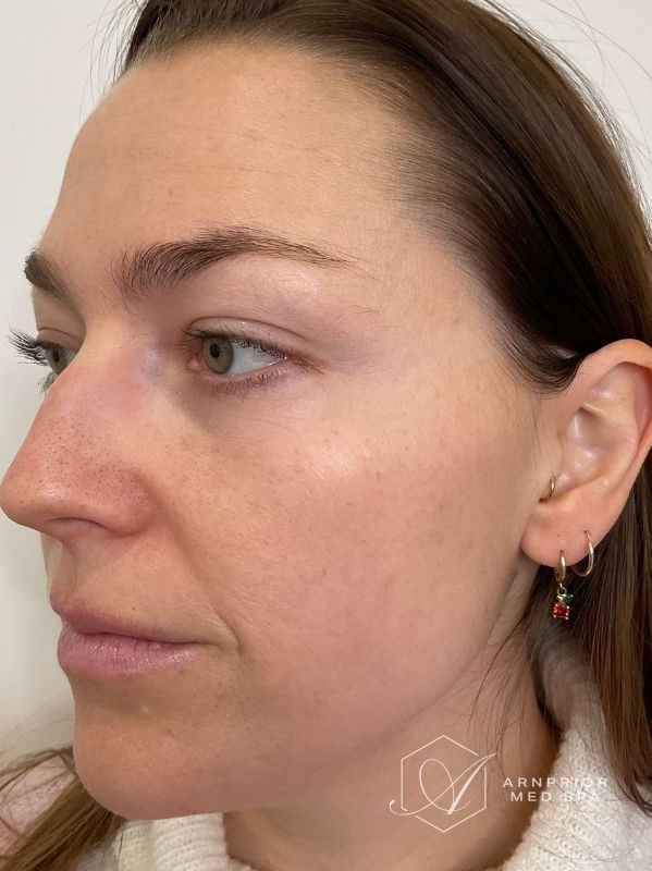 Pigmentation after LaseMD Ultra fractional laser resurfacing at Arnprior Med Spa