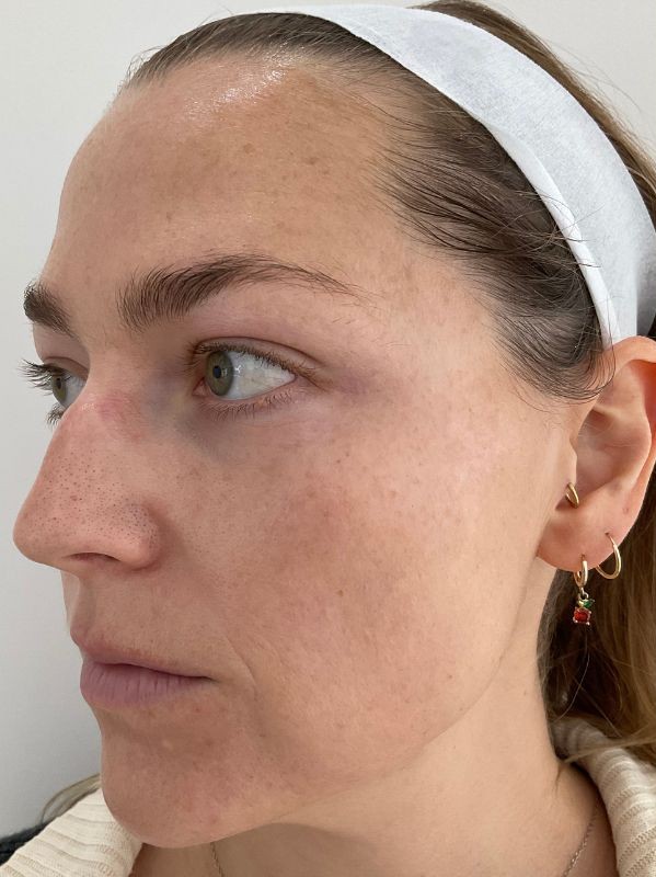 Pigmentation before LaseMD Ultra fractional laser resurfacing at Arnprior Med Spa