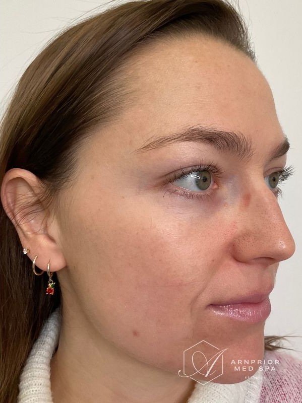 Pigmentation after 1 laser skin resurfacing treatment with LaseMD Ultra