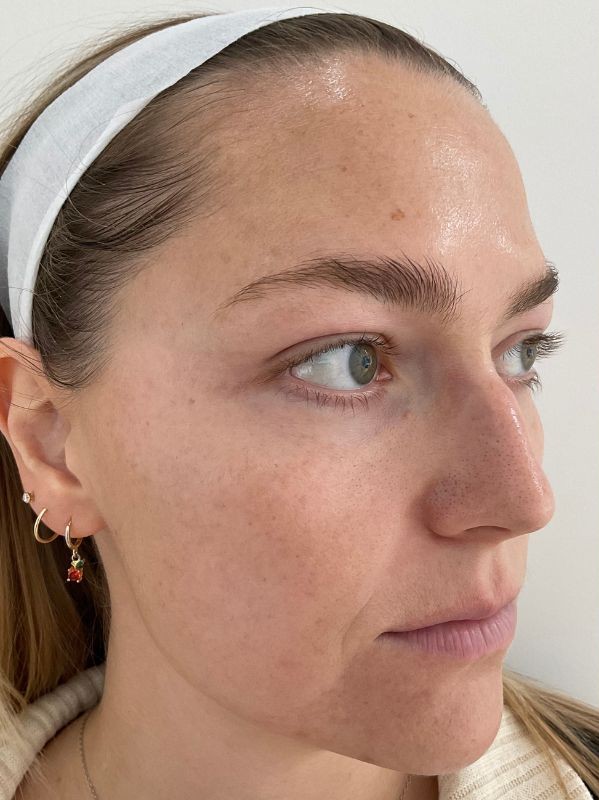 Pigmentation before 1 laser skin resurfacing treatment with LaseMD Ultra