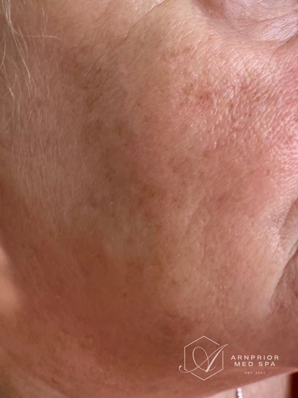 Hyperpigmentation after Hollywood Spectra laser toning treatment