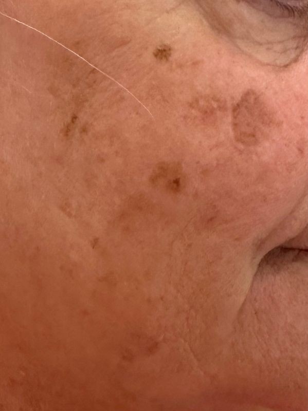 Hyperpigmentation before Hollywood Spectra laser toning treatment