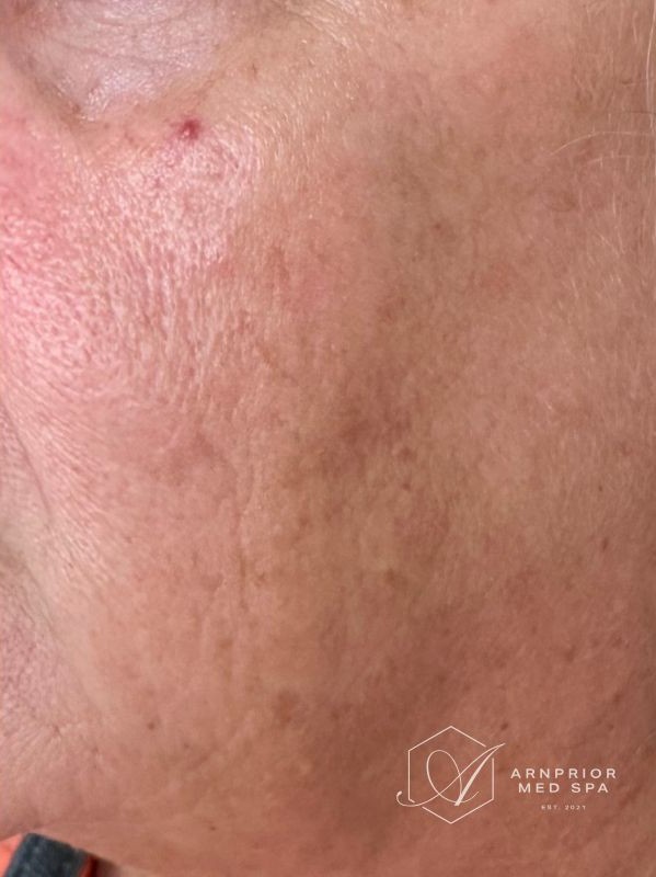 Hyperpigmentation after laser toning treatment