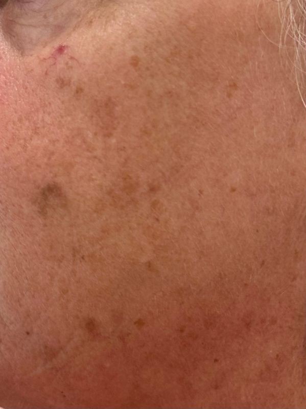 Hyperpigmentation before laser toning treatment