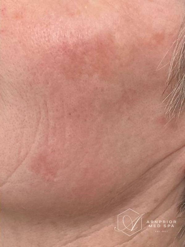 Pigmentation after MDF Spectra Toning Facial