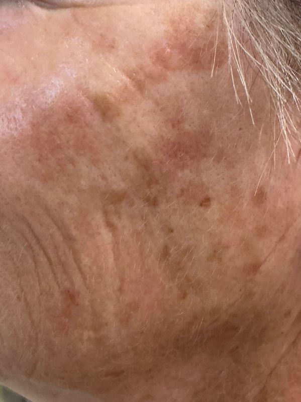 Pigmentation before MDF Spectra Toning Facial