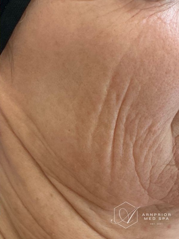 Pigmentation after MDF Spectra Toning Facial