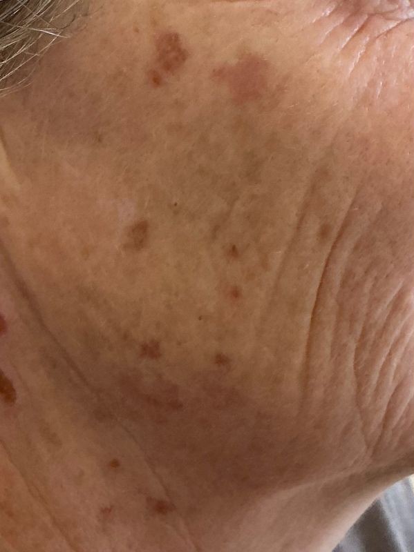 Pigmentation before MDF Spectra Toning Facial