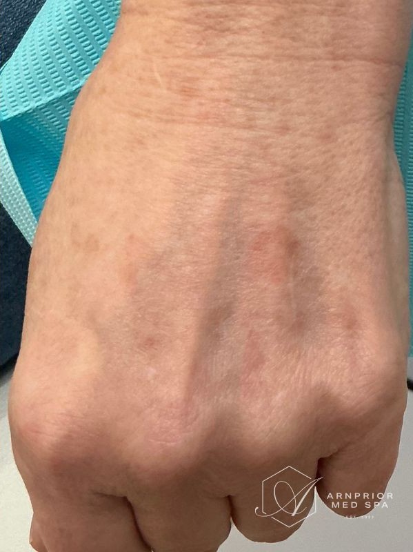 Pigmentation treatment on hands after 1 laser skin resurfacing session with LaseMD Ultra, after