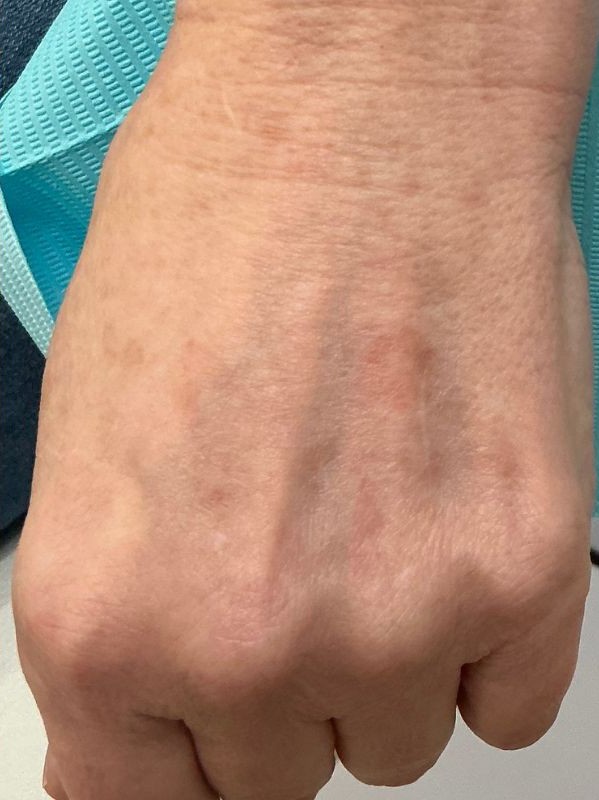hand sun spot after laser resurfacing