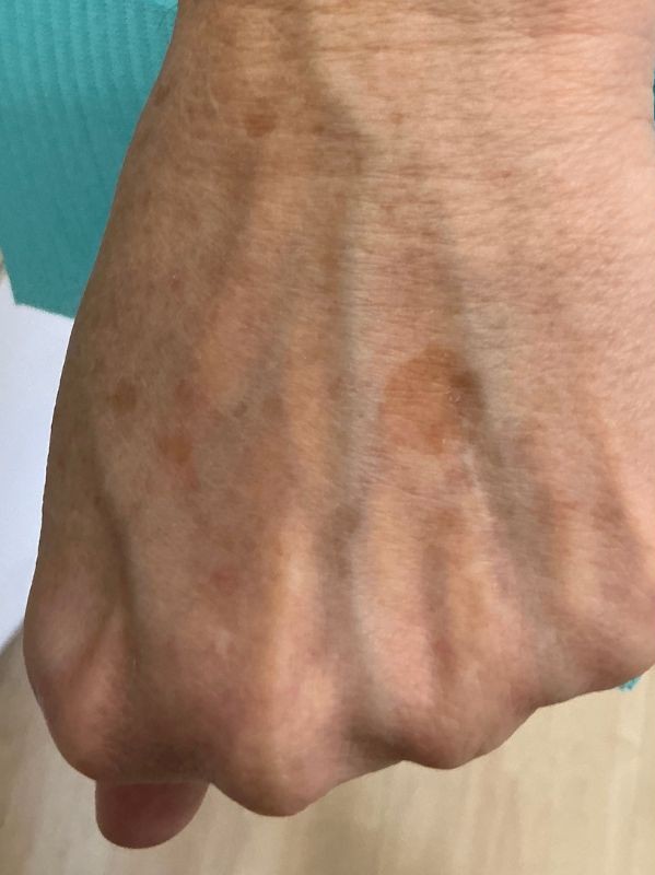 hand sun spot before laser resurfacing