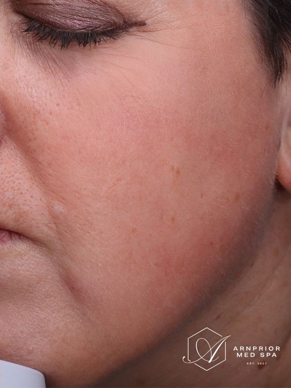 Hyperpigmentation after LaseMD Ultra and CO2 Laser