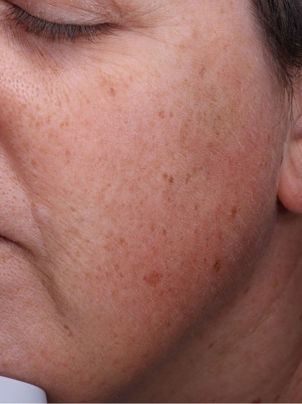 Hyperpigmentation before LaseMD Ultra and CO2 Laser