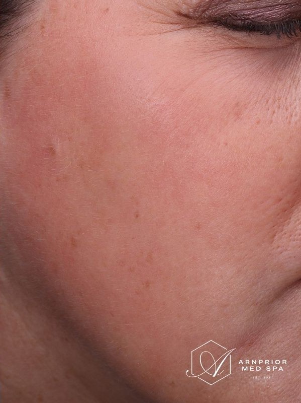 Hyperpigmentation after LaseMD Ultra and CO2 Laser