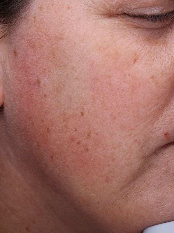 Hyperpigmentation before LaseMD Ultra and CO2 Laser