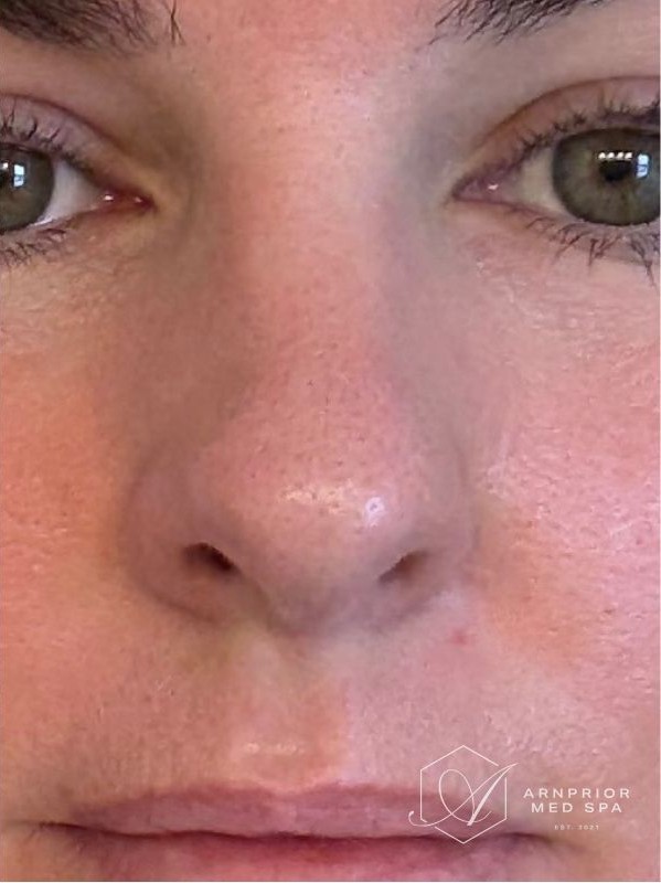 Enlarged pores across the nose and cheek after CO2 skin resurfacing at Arnprior Med Spa
