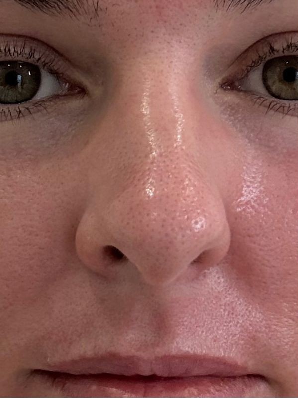 Close-up of enlarged pores across the nose and cheeks at Arnprior Med Spa