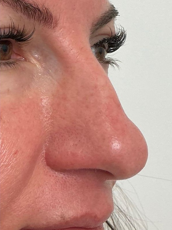 Pore refinement with CO2 Resurfacing, after