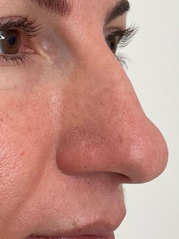 Pore refinement with CO2 Resurfacing, before