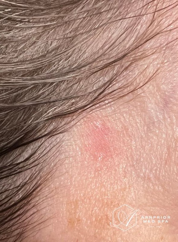 Port wine stain after removal with vascular laser