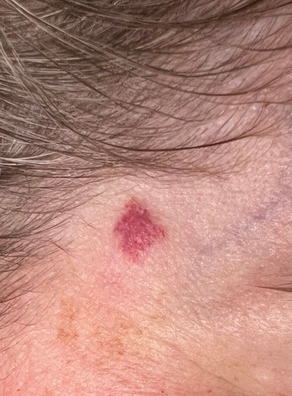 Port wine stain before removal with vascular laser