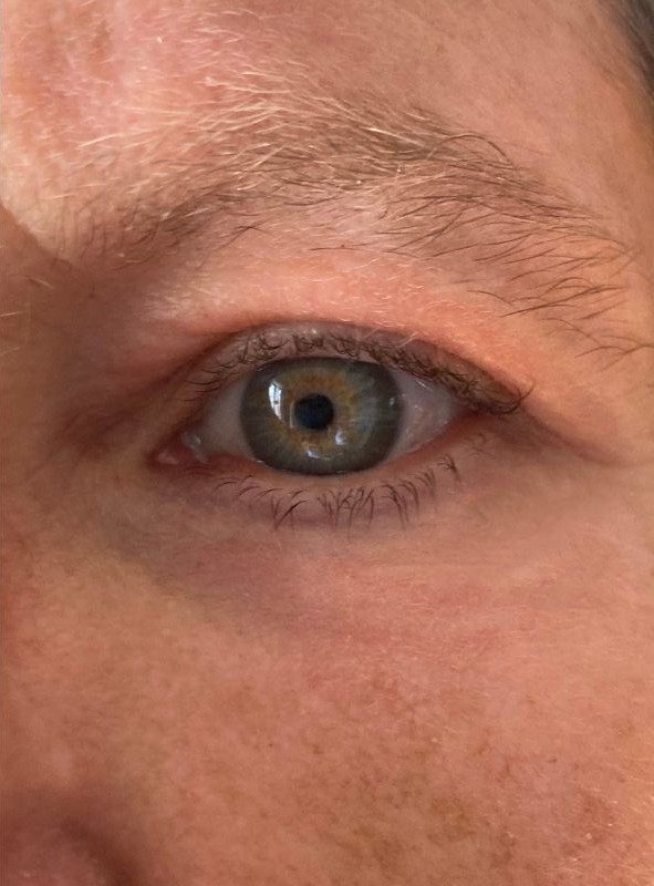 Non surgical blepharoplasty after
