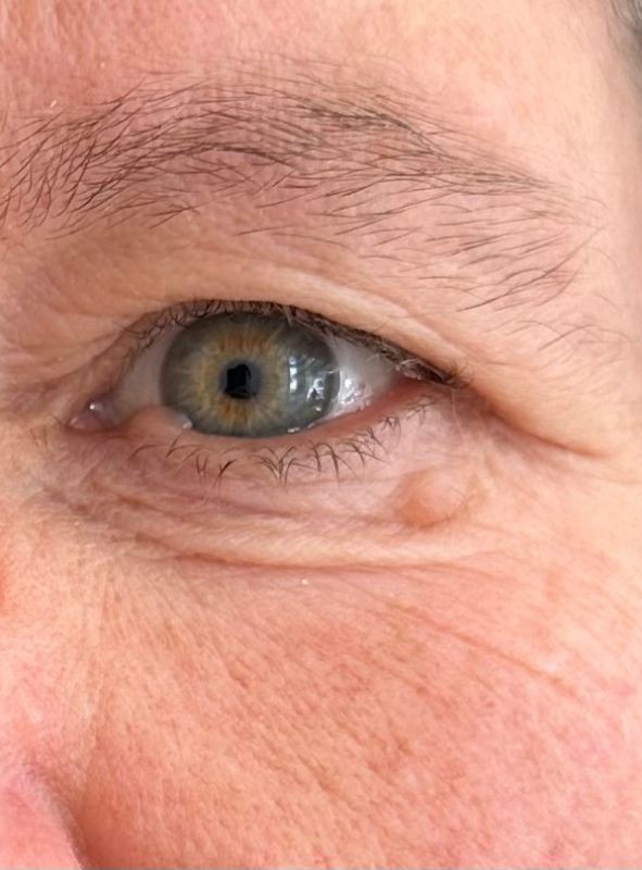 Non surgical blepharoplasty before