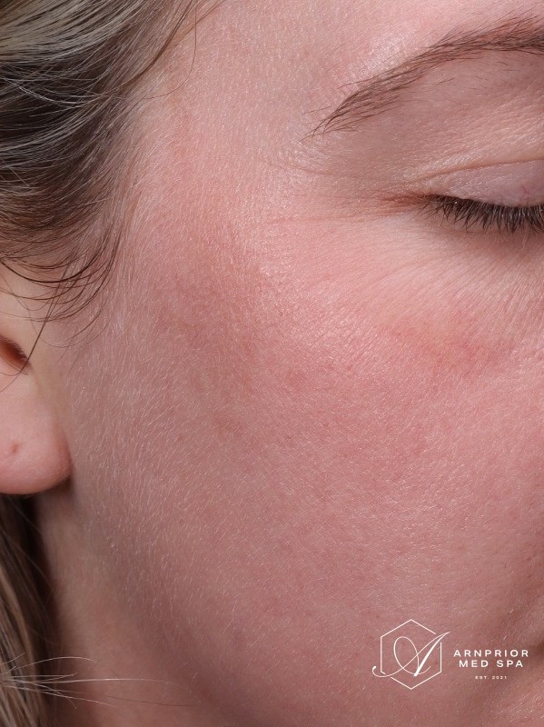 after, lighter patch of facial pigmentation on the cheek, Arnprior Med Spa