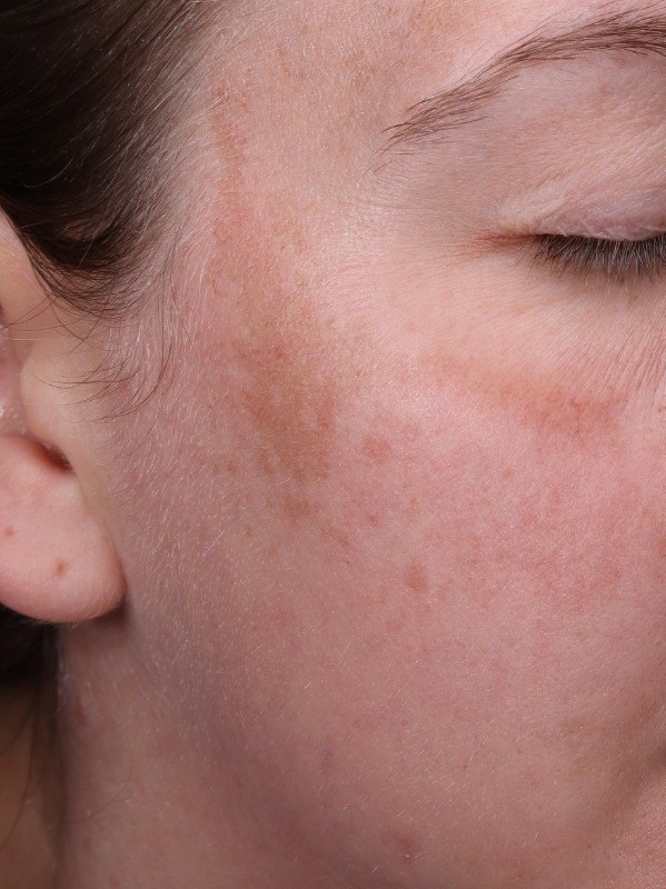 before, lighter patch of facial pigmentation on the cheek, Arnprior Med Spa